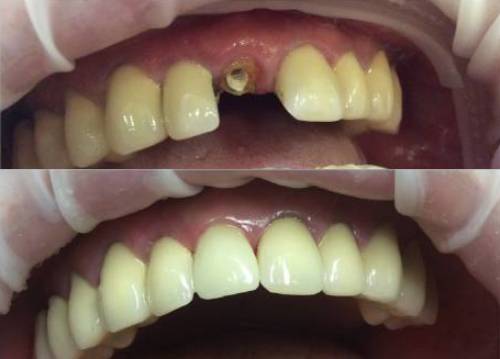 восстановление зуба